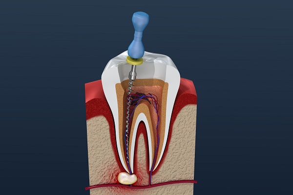 root canal travel