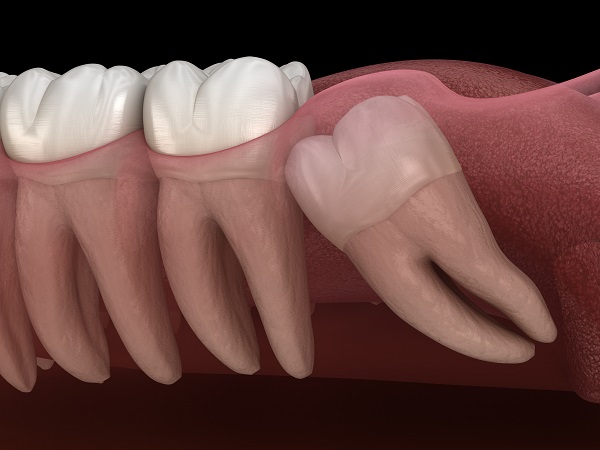 Wisdom Teeth Extraction Grand Junction, CO
