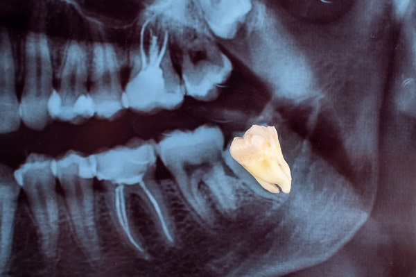 Wisdom Tooth Extraction Grand Junction, CO